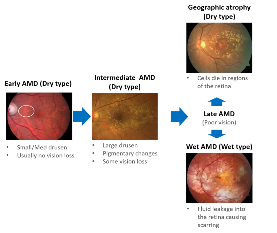 Macular degeneration (Dry form)